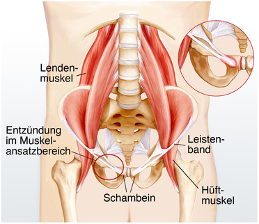 Schwangerschaftsbedingte Symphysenlockerung Schwangerschaft Net